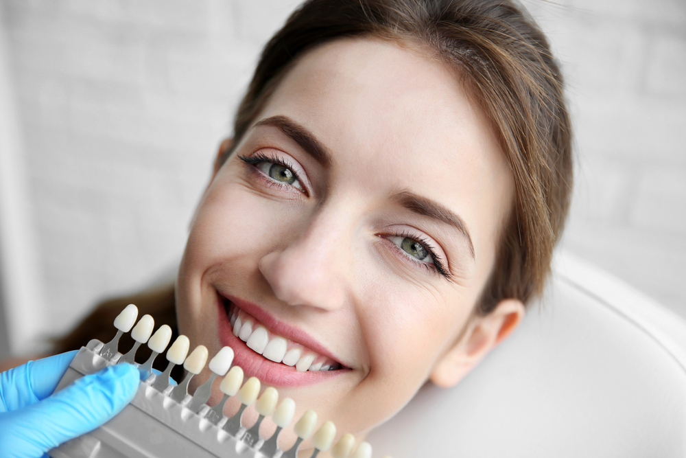 Dental veneers
