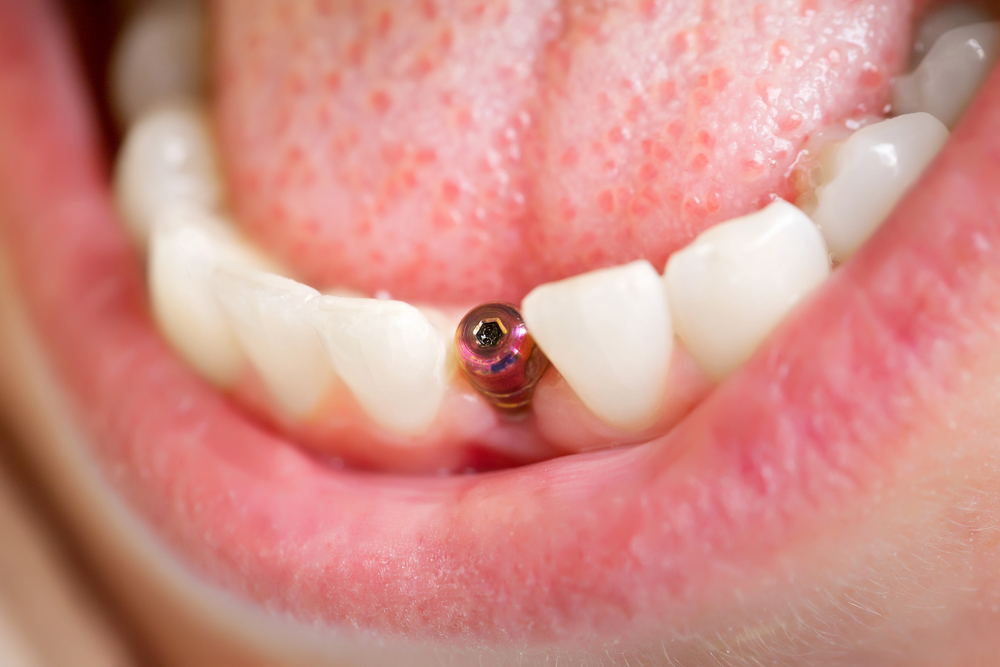 dental implants