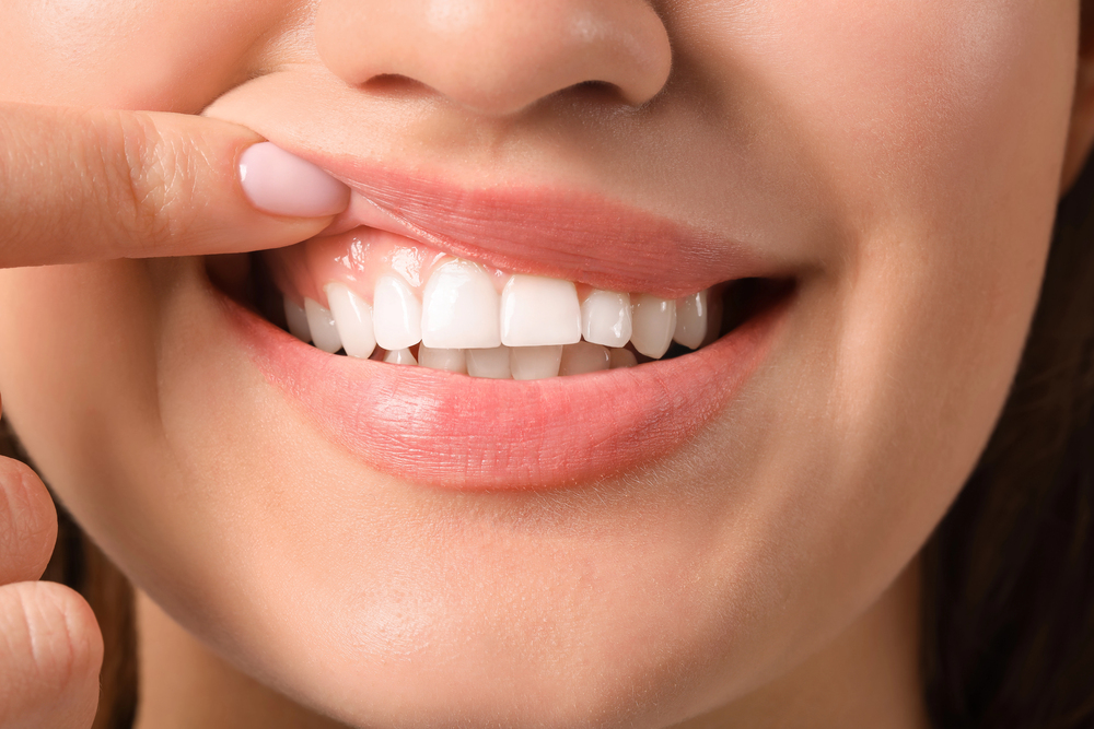 dental implants
